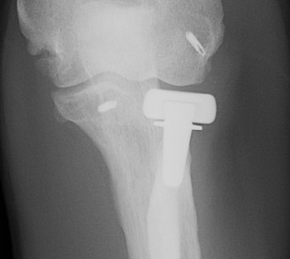 Radial Head Replacement Lysis AP